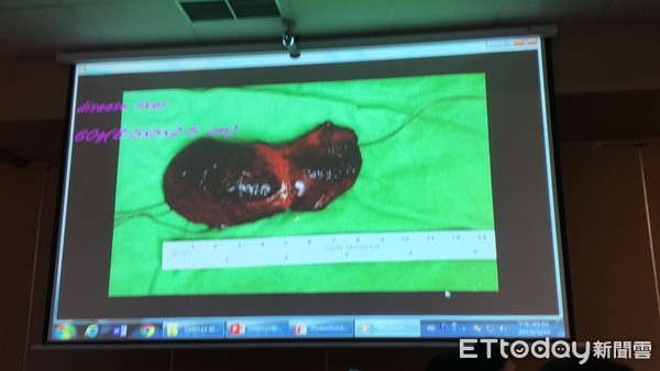 ▲媽坐月子切肝救罕病兒! 北榮幫25天娃換肝「再創全台紀錄」。(圖/記者嚴云岑攝)