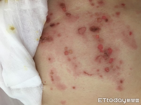 ▲黑面馬,水泡。(圖/彰化醫院提供)