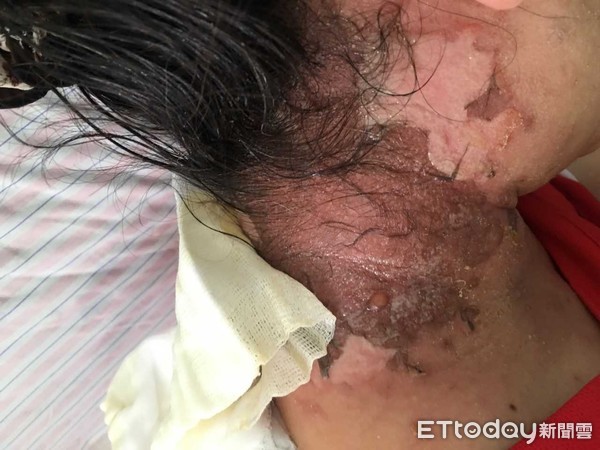 ▲黑面馬,水泡。(圖/彰化醫院提供)