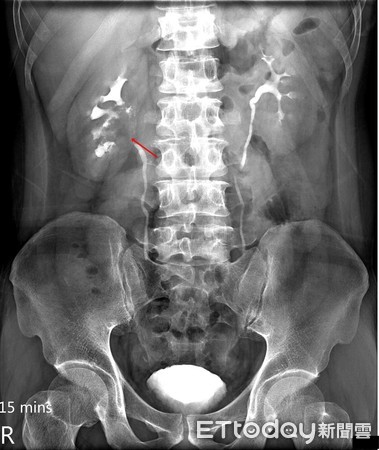 ▲▼。(圖/亞洲大學附設醫院提供)