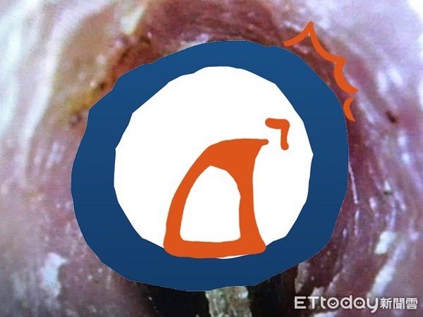 ▲▼喉嚨有蟲飛進去產卵。(圖/大林慈濟提供)