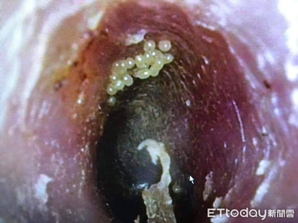 ▲▼喉嚨有蟲飛進去產卵。(圖/大林慈濟提供)