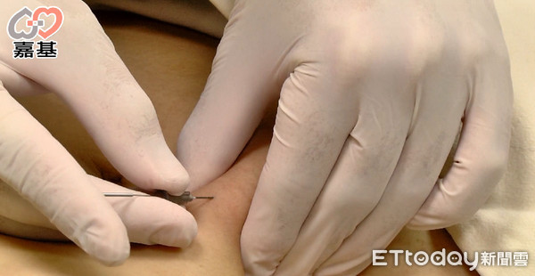 ▲▼針灸是藉由不銹鋼針在穴道刺激達到促進代謝和氣血循環的作用;穴位埋線是針灸的延伸,也是中西醫學相結合的具體成果。(圖/嘉義基督教醫院提供)