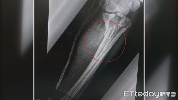 ▲陳先生因車禍造成左膝粉碎性骨折（紅圈處），並影響血液循環，差點要被截肢。（圖／記者黃孟珍翻攝）