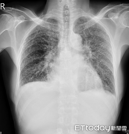 ▲▼從樹上摔落...意外發現「矽肺症」! 醫籲這5職業超危險。(圖/亞大醫院提供)