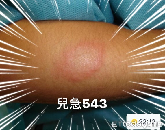 ▲隱翅蟲叮咬皮膚。(圖/吳昌騰醫師提供)