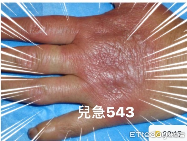 ▲隱翅蟲叮咬皮膚。(圖/吳昌騰醫師提供)