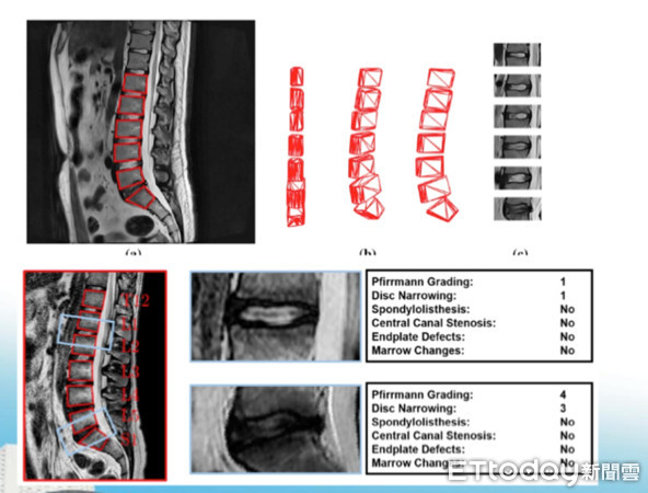 ▲AI判讀脊椎骨折。(圖/周伯鑫醫師提供)