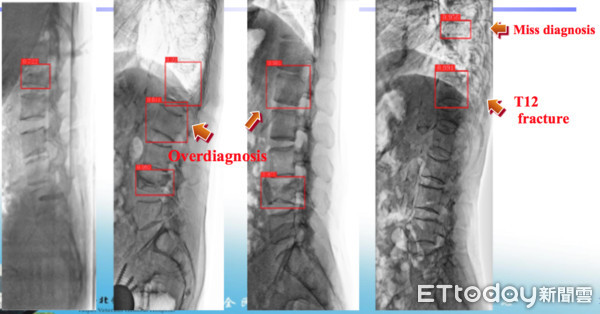 ▲AI判讀脊椎骨折。(圖/周伯鑫醫師提供)
