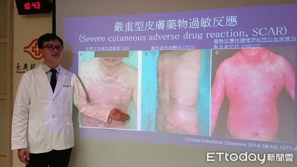 ▲長庚藥物過敏。(圖/長庚醫院提供)