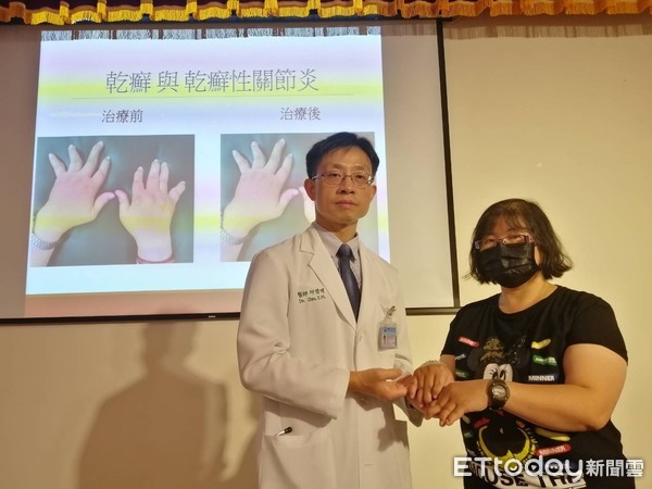 乾癬性關節炎。(圖/中國附醫提供)