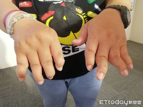 乾癬性關節炎。(圖/中國附醫提供)