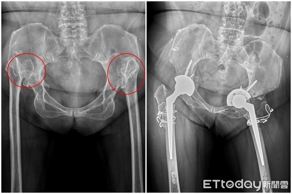 ▲▼亞大醫院骨科部主任唐國民指出患部位置。 (圖/亞大醫院提供)