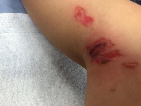 ▲▼英國11歲少女雙腿遭美甲膠嚴重灼傷。（圖／翻攝自FB／Louise Worsfold）