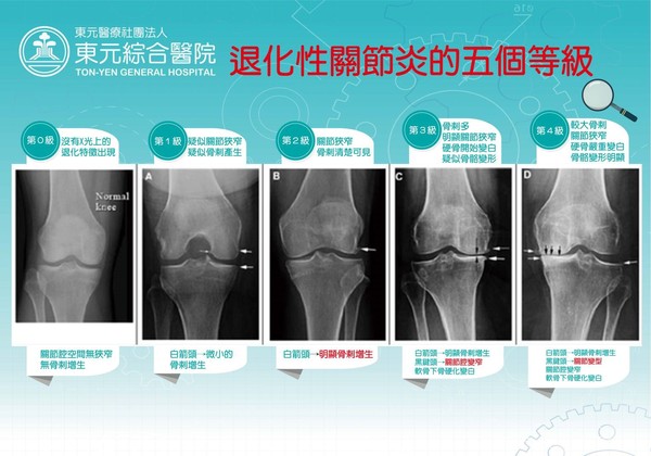 ▲P.R.P.合併玻尿酸　膝關節病變、韌帶損傷治療新選擇。（圖／東元醫院提供）