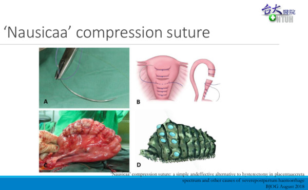 ▲▼臺大醫院新縫合技術「Nausicaa(王蟲)縫合法」有效降低產後大出血出血量及死亡率。（圖／台大醫院提供）