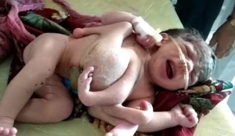 ▲印度小女嬰出生竟被原本該有的第三胎殘肢包住。（圖／翻攝自punjabkesari.in）