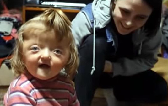 ▲俄羅斯一名小女孩因為臉部畸形幼稚園拒收。（圖／翻攝自vk）