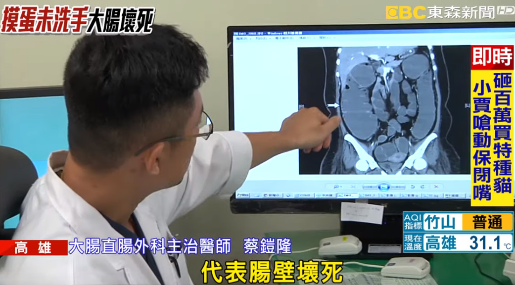 ▲▼大腸9成壞死。（圖／翻攝《東森新聞》）