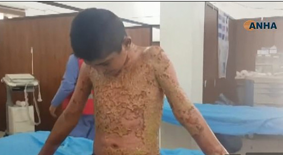 ▲敘利亞男童遭到化學武器炸傷，全身如碎瓦牆剝落。（圖／翻攝自ANHA）