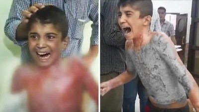 皮膚一片片剝落！敘利亞五歲童哭喊「拜託停戰」送到醫院傷口還在冒煙