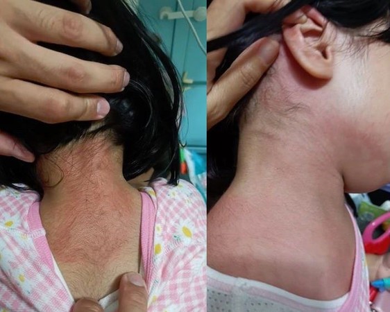 ▲香港屯門3歲女童皮膚紅腫，疑似受「不明毒氣」影響。（圖／翻攝自朱凱迪臉書粉絲專頁）