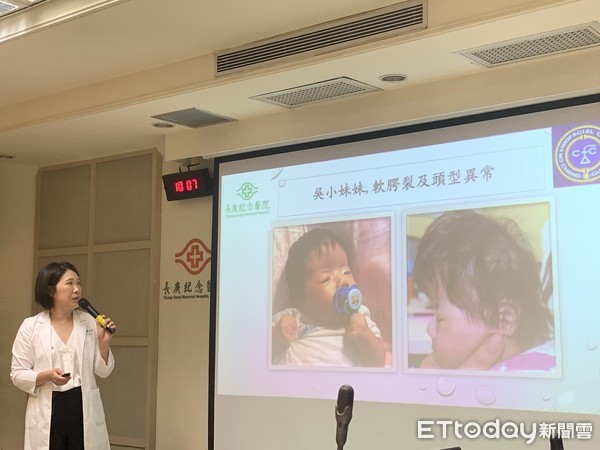 ▲顱縫早閉 。(圖/記者嚴云岑攝) ▲顱縫早閉 。(圖/記者嚴云岑攝)