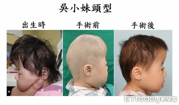 ▲吳小妹顱縫早裂。(圖/嘉義長庚提供) ▲吳小妹顱縫早裂。(圖/嘉義長庚提供)