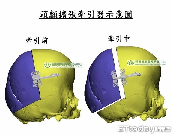 ▲頭顱擴張牽引器。(圖/長庚醫院提供) ▲頭顱擴張牽引器。(圖/長庚醫院提供)