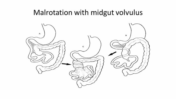 ▲先天性腸扭轉。(圖/吳昌騰醫師提供) ▲先天性腸扭轉。(圖/吳昌騰醫師提供)