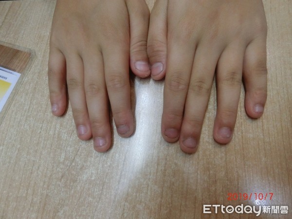▲10歲男童咬指甲咬到變形。（圖／柯適中醫師提供）