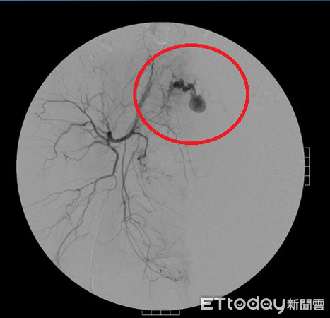 剖腹產出雙胞胎 產後4週發生大出血!(圖/國泰醫院提供) 剖腹產出雙胞胎 產後4週發生大出血!(圖/國泰醫院提供)