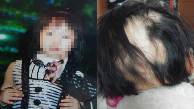 韓國妹莫名掉髮「後腦變禿饅頭」　加濕機殺菌劑奪千人命：已用了30年！
