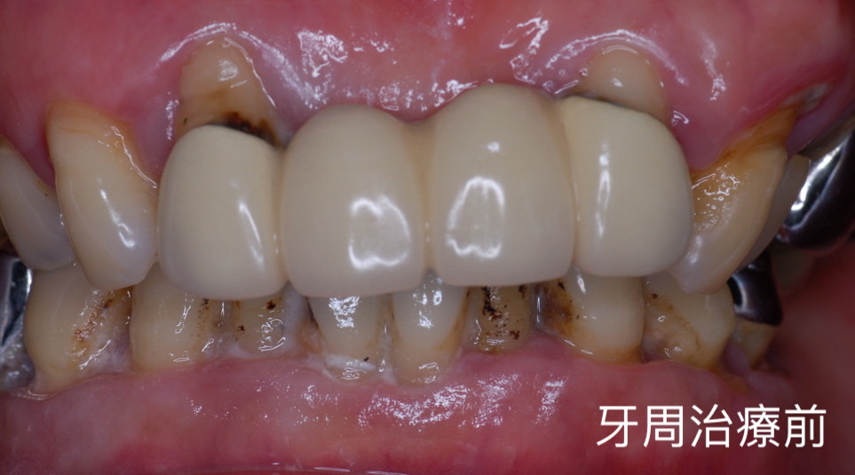 ▲牙周病。(圖/康捷診所提供) ▲牙周病。(圖/康捷診所提供)
