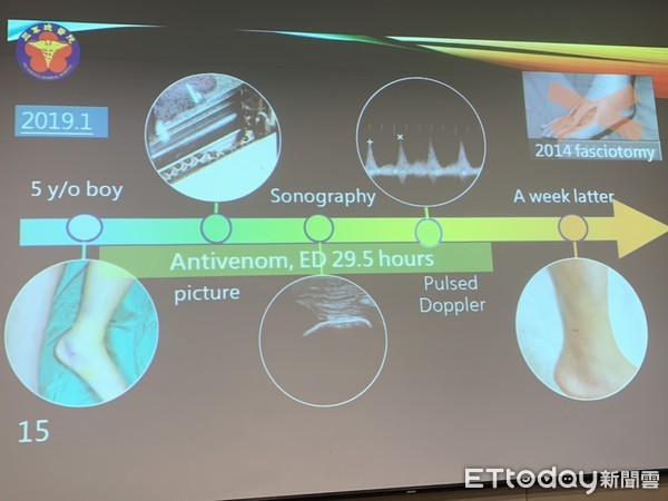 ▲超音波介入優化蛇咬傷病人治療情形。(圖/記者嚴云岑攝) ▲超音波介入優化蛇咬傷病人治療情形。(圖/記者嚴云岑攝)