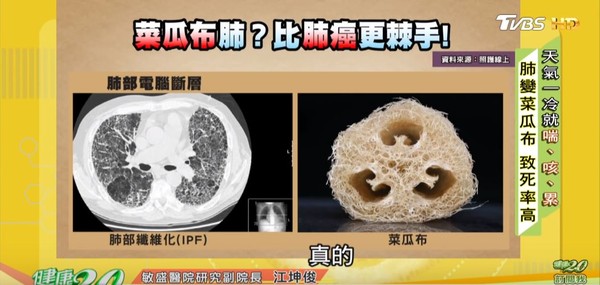 ▲▼菜瓜布肺比肺癌還棘手。(圖/截自健康2.0) ▲▼菜瓜布肺比肺癌還棘手。(圖/截自健康2.0)