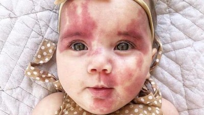嘲笑「被平底鍋燙過的臉」！女嬰胎記遭酸民攻擊　母氣哭：她不到兩歲耶