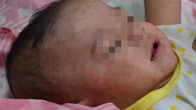 1人能傳染15人！麻疹「怪物級傳染力」靠空氣就能傳播　2018台灣也曾遭殃