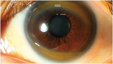 ▲威爾森氏症病患的眼睛會因為銅離子堆積而有典型的棕綠色環。（圖／《QJM: An International Journal of Medicine》／臺大醫院新竹分院提供             。