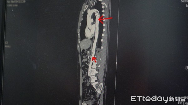 ▲男子主動脈嚴重剝離（箭頭指細黑線部分）。（圖／記者吳奕靖攝）