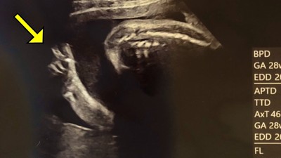 揪心！孕婦因志村健去世崩潰　產檢見肚裡胎兒「右手比YA」爆哭