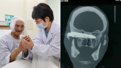 頭痛就醫才知「刀片插腦26年」　老翁撿回一命泣：醫師讓我重生