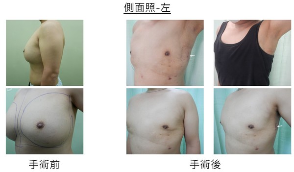 ▲▼男子因霸凌長期施打沙拉油進乳房中。(圖/彰基提供) ▲▼男子因霸凌長期施打沙拉油進乳房中。(圖/彰基提供)