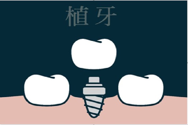 ▲▼缺牙除了選擇植牙,還有其他2種方式可以選擇。(圖/醫師游惠捷提供) ▲▼缺牙除了選擇植牙,還有其他2種方式可以選擇。(圖/醫師游惠捷提供)