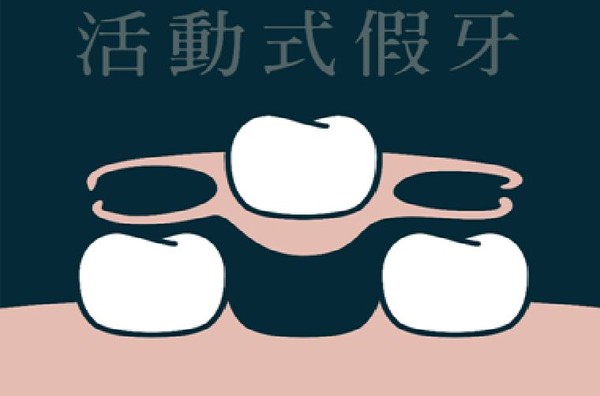 ▲▼缺牙除了選擇植牙,還有其他2種方式可以選擇。(圖/醫師游惠捷提供) ▲▼缺牙除了選擇植牙,還有其他2種方式可以選擇。(圖/醫師游惠捷提供)