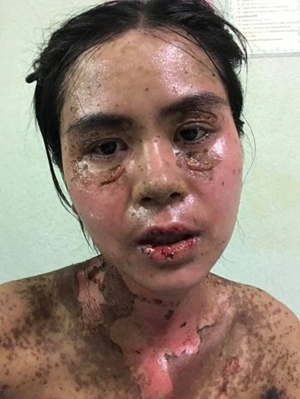 ▲泰國一名女子因為自行服用止痛藥，造成過敏全身如燒焦一般。（圖／翻攝自當事人臉書）