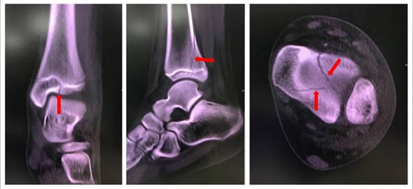 ▲▼踝關節遠端脛骨三平面型骨折。(圖/嘉義長庚醫院提供) ▲▼踝關節遠端脛骨三平面型骨折。(圖/嘉義長庚醫院提供)