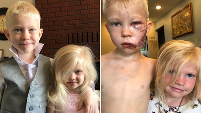 6歲男孩捨身救親妹　遭狗咬傷送醫縫90針　美隊親自拍片讚「真英雄」