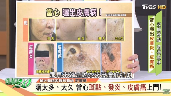 ▲▼因紫外線會抑制皮膚免疫系統的功能,若是本身就有肝斑或是雀斑等問題,再經過紫外線的照射,容易使問題惡化。(圖/截自健康2.0) ▲▼因紫外線會抑制皮膚免疫系統的功能,若是本身就有肝斑或是雀斑等問題,再經過紫外線的照射,容易使問題惡化。(圖/截自健康2.0)