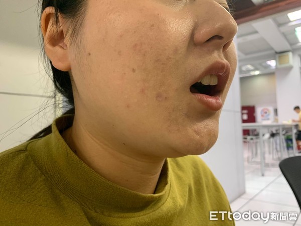 ▲▼顏面神經師調、嘴角冒泡。(圖/記者簡仲豪攝) ▲▼顏面神經師調、嘴角冒泡。(圖/記者簡仲豪攝)